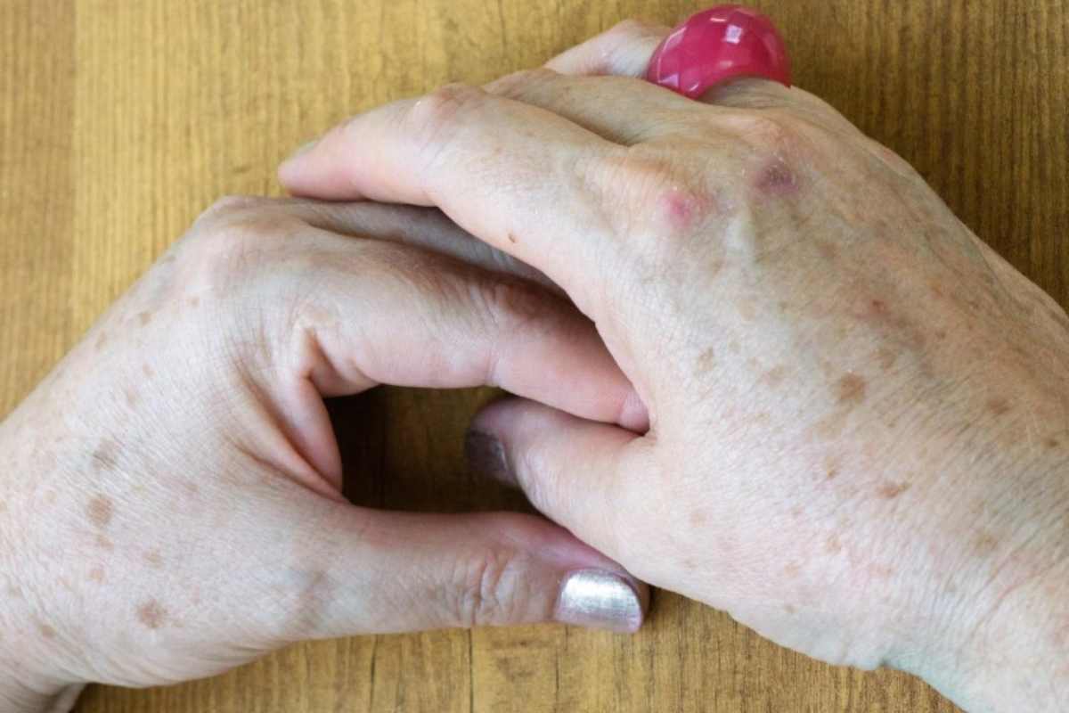 Pelle, macchie scure