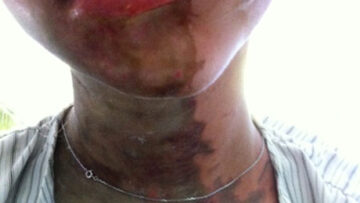 Zanzibar_acid_attack_women skin graft
