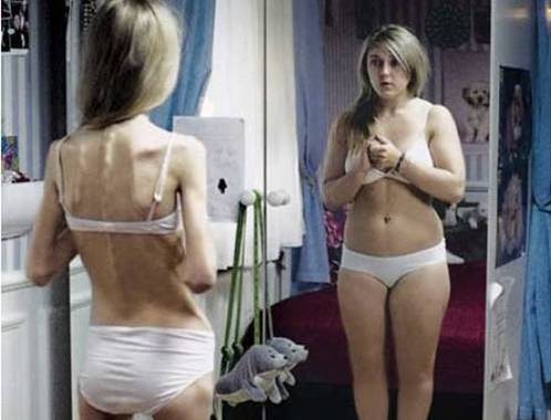 Anoressia: coinvolto anche un gene. Risultato di un maxi studio