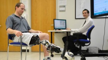 La gamba bionica funziona: per muoverla basta il pensiero