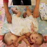 Cina gemelli siamesi abbandonati in un orfanotrofio 01