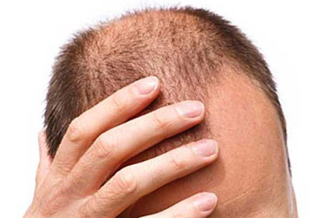 Trapianto di capelli, 5 cose che devi sapere prima di farlo
