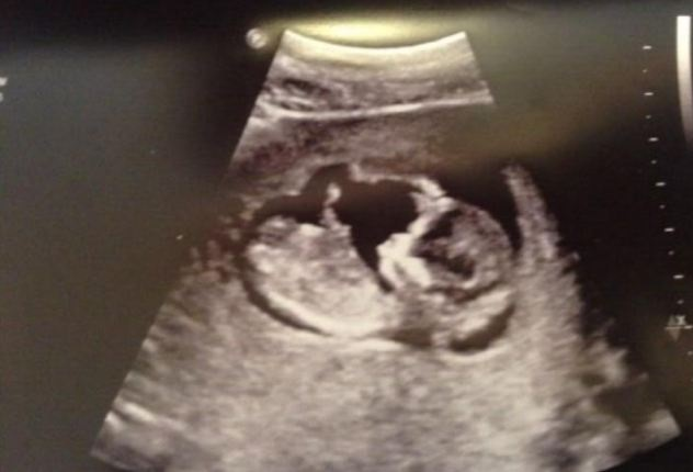 GB, Josie Cunningham pronta ad abortire: "Così posso fare il Grande Fratello"