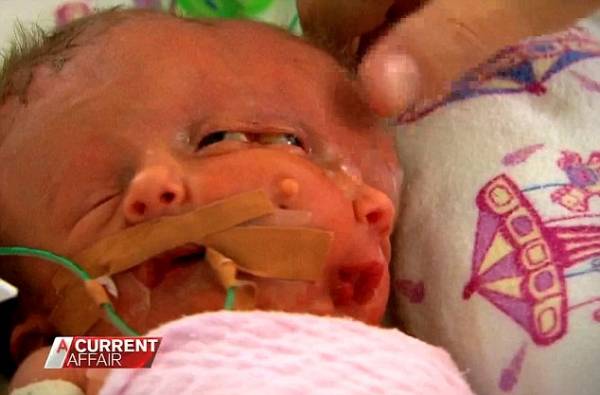 Australia: partorisce gemelli siamesi con un cuore e due teste