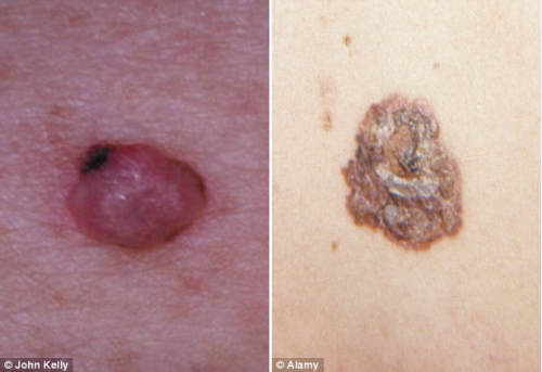 "Sembra brufolo ma è un tumore": dermatologi, allarme melanoma nodulare
