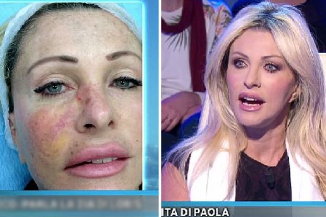 Paola Ferrari confessa: "Un tumore mi stava mangiando il viso" FOTO