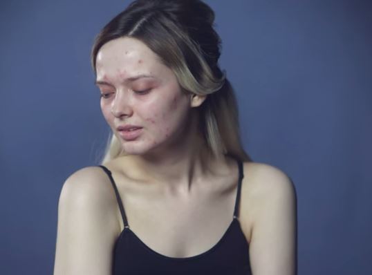 Em Ford, la blogger con l'acne commuove il web VIDEO