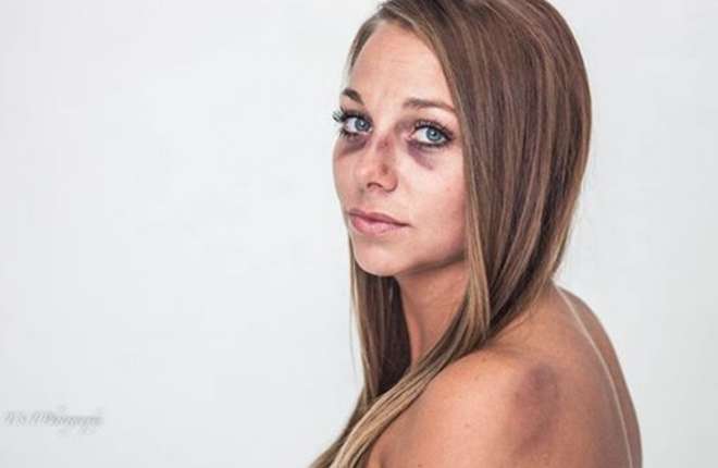 Ragazza picchiata dal fidanzato mostra lividi: foto è virale