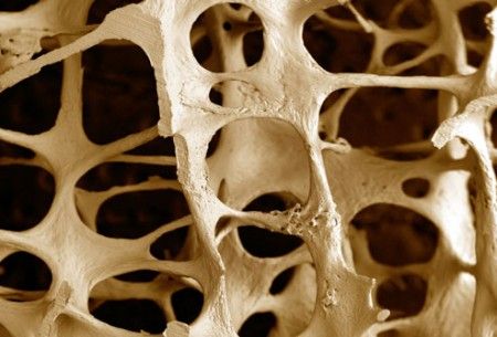 Osteoporosi, uomini over 50 sempre più a rischio fratture