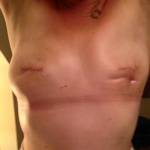 Amanda Stewart, FOTO mastectomia su Fb: "Cancro, hai perso"2