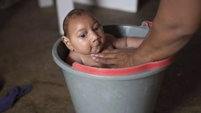 Microcefalia, neonati con testa piccola: epidemia in Brasile