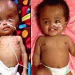 Haiti, neonata con malformazione adottata3
