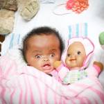 Haiti, neonata con malformazione adottata7