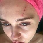 Miley Cyrus aggredita dal suo gatto: graffi in testa FOTO