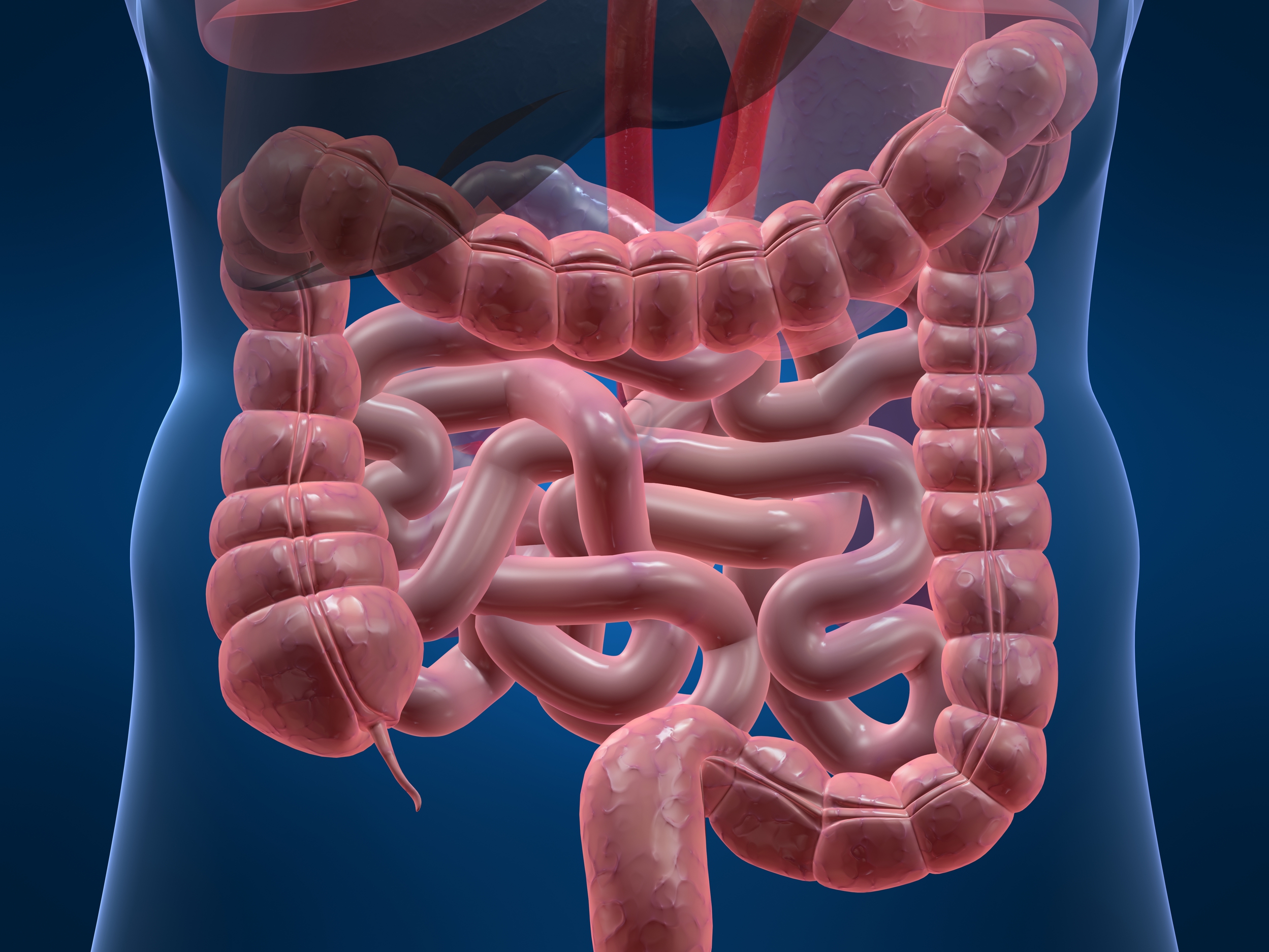 Cancro intestino, un tubo nel corpo per evitare la colostomia
