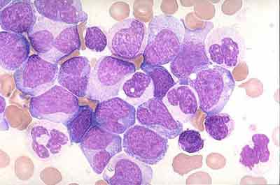 Leucemia mieloide cronica, AIL: "Guarisce un paziente su due"