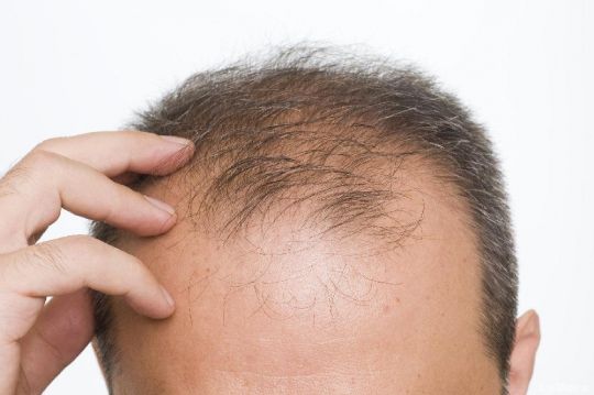 Alopecia, farmaco per artrite reumatoide fa ricrescere capelli