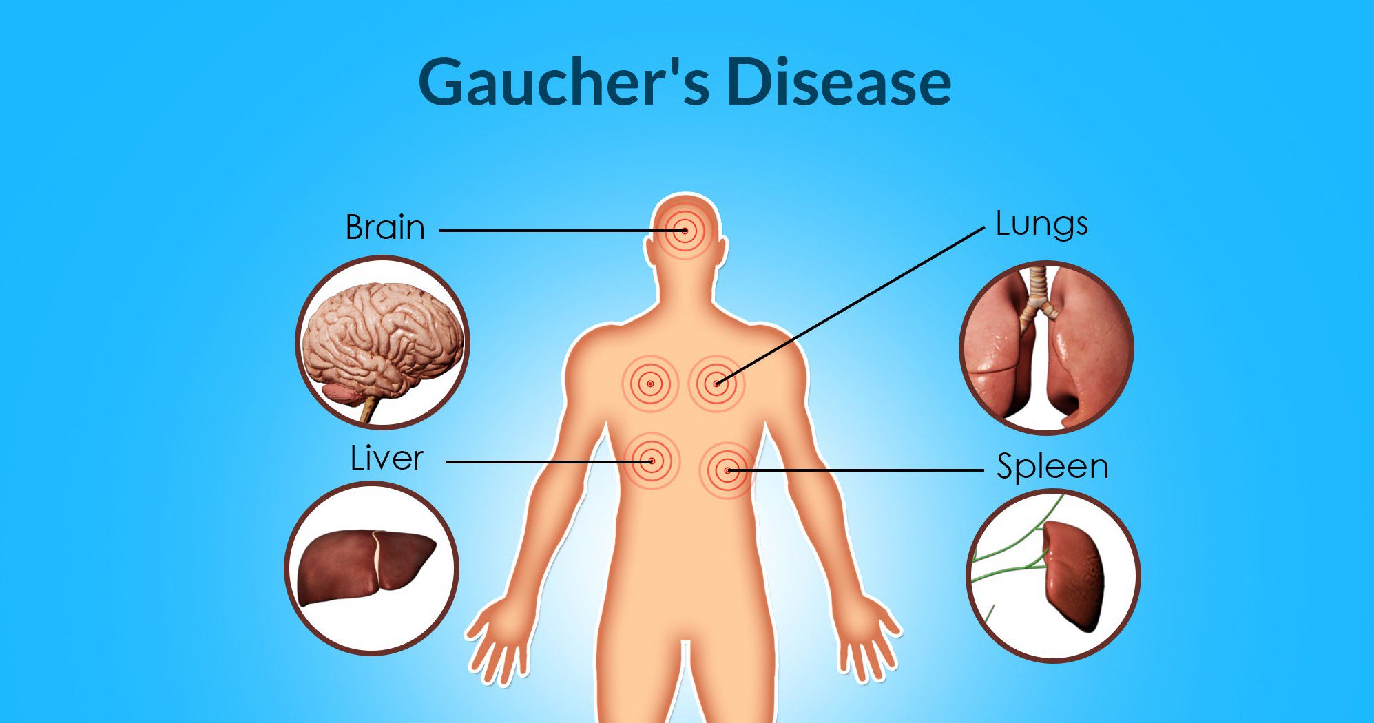 Malattia di Gaucher, medici chiedono terapia domiciliare