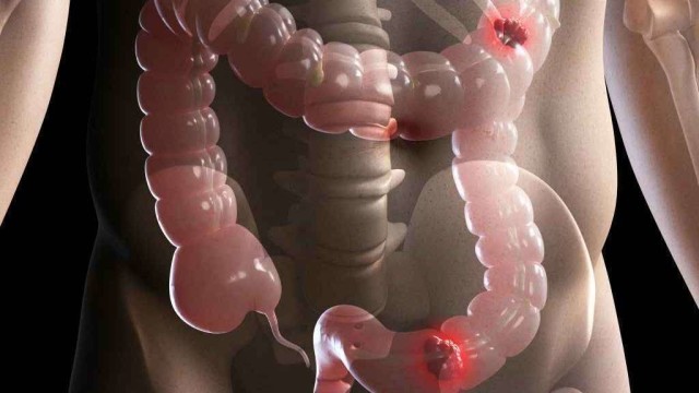 Tumore intestino, vita sana riduce rischio negli uomini