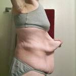 Celia perde 100 chili: ora ha 9 chili di pelle in eccesso4