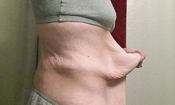 Celia perde 100 chili: ora ha 9 chili di pelle in eccessofff