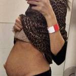 Fibroma all'utero da 2,7 kg FOTO La gente le chiedeva: "Sei incinta?"3