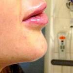 Iniezioni su labbra per averle più carnose: ecco cosa le succede