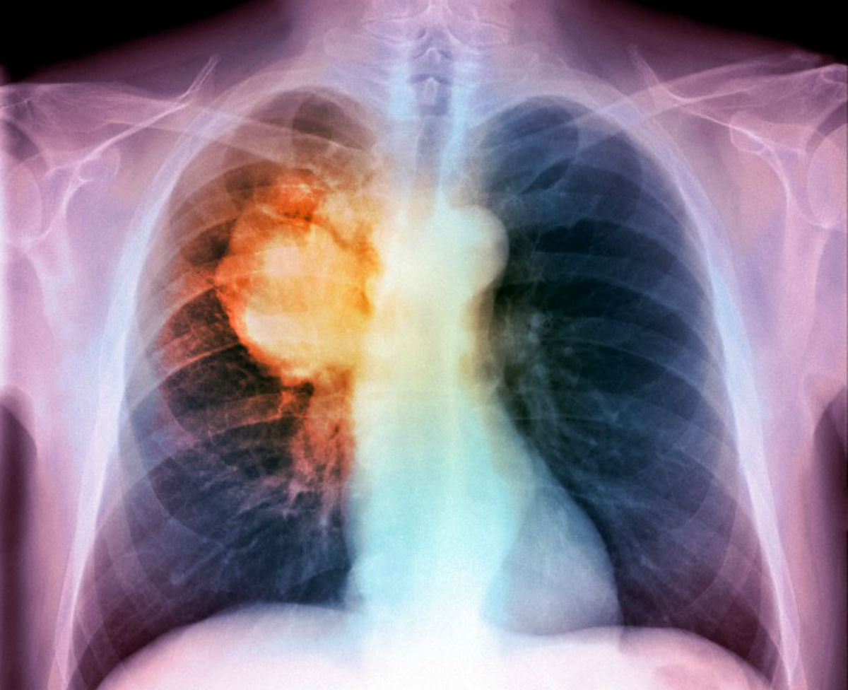 Tumore al polmone, cambia la cura. Pembrolizumab efficace al 70%