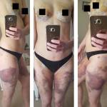 Masectomia preventiva al seno: pubblica FOTO lividi e cicatrici
