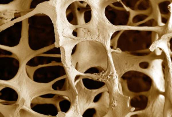 Osteoporosi anche per gli uomini: fratture al femore e vertebrali