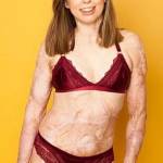Catrin ha cicatrici sul 96% del corpo: ora posa per incoraggiare quelli come lei FOTO