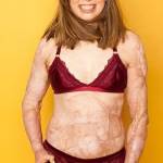 Catrin ha cicatrici sul 96% del corpo: ora posa per incoraggiare quelli come lei FOTO
