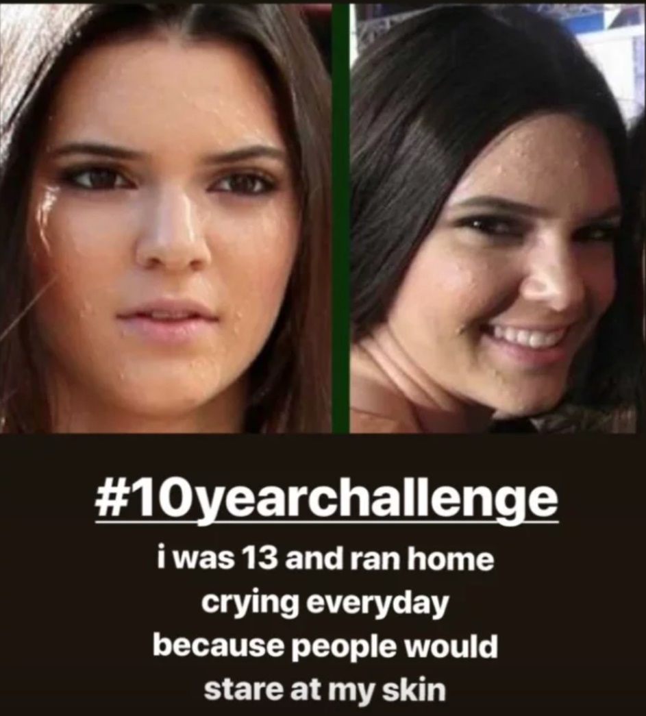 Kendall Jenner, il suo "10 year Challenge" svela che da adolescente aveva l'acne