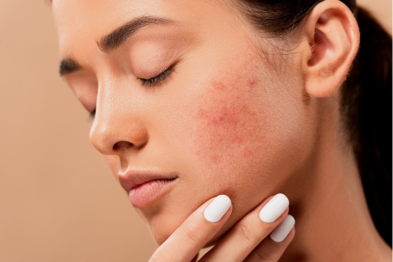 Questa crema anti brufoli è una delle più efficaci contro l'acne