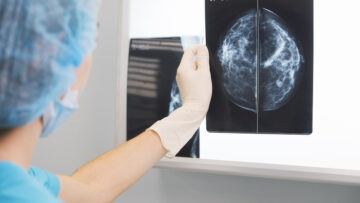 Mammografia può fare da spia per problemi al cuore in menopausa