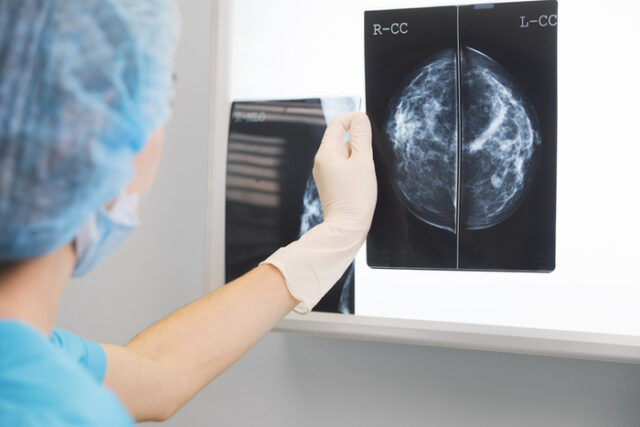 Mammografia può fare da spia per problemi al cuore in menopausa