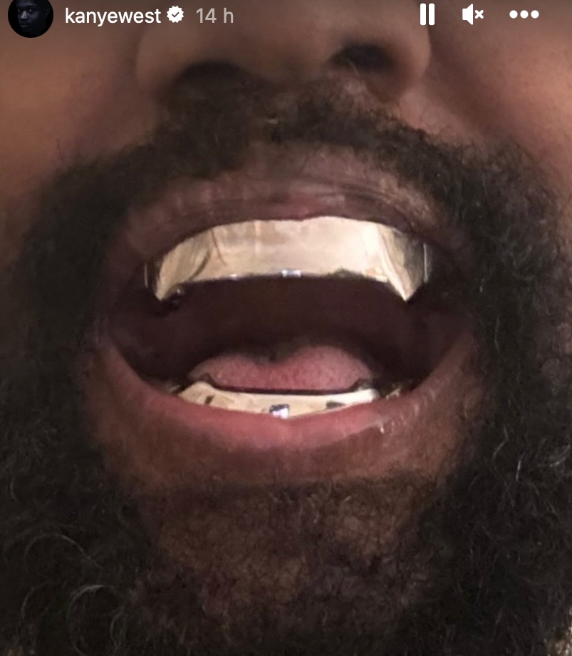 Kanye West, denti in titanio su una storia Instragram