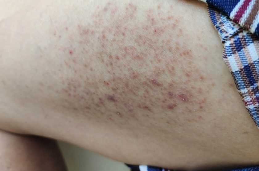 Pelle, macchie scure